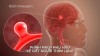 Phát hiện sớm phình mạch máu não bằng MRI/MRA/CT – Chủ động bảo vệ não bộ