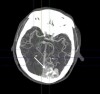 Bệnh Viện Đa Khoa Cẩm Phả Phát Hiện Dị Dạng Mạch Máu Não Qua Thăm Khám Và Chẩn Đoán Hình Ảnh
