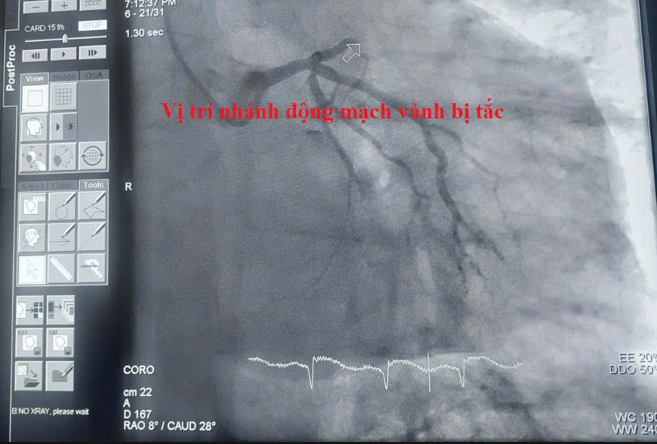 Thời gian vàng cứu sống trái tim: Bệnh viện Đa khoa Cẩm Phả liên tiếp cấp cứu thành công nhiều ca nhồi máu cơ tim cấp