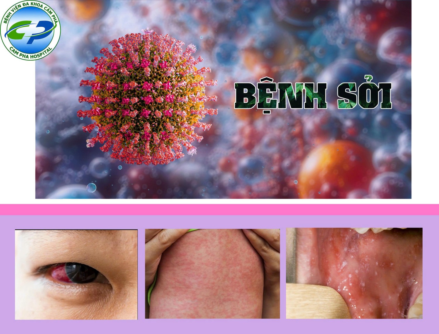 KHUYẾN CÁO PHÒNG, CHỐNG BỆNH SỞI